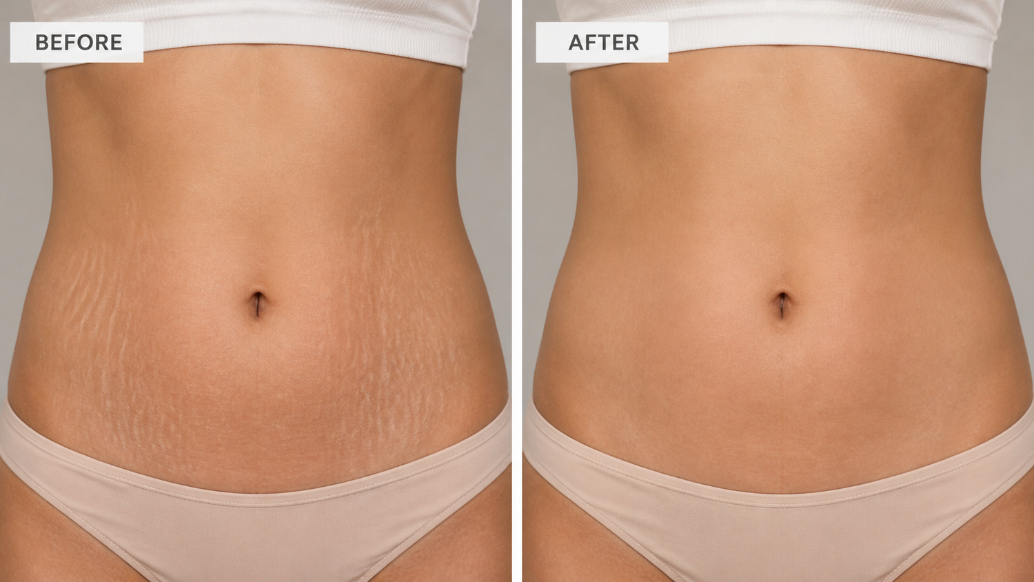 Before and after red light therapy for stretch marks - skin improvement comparison