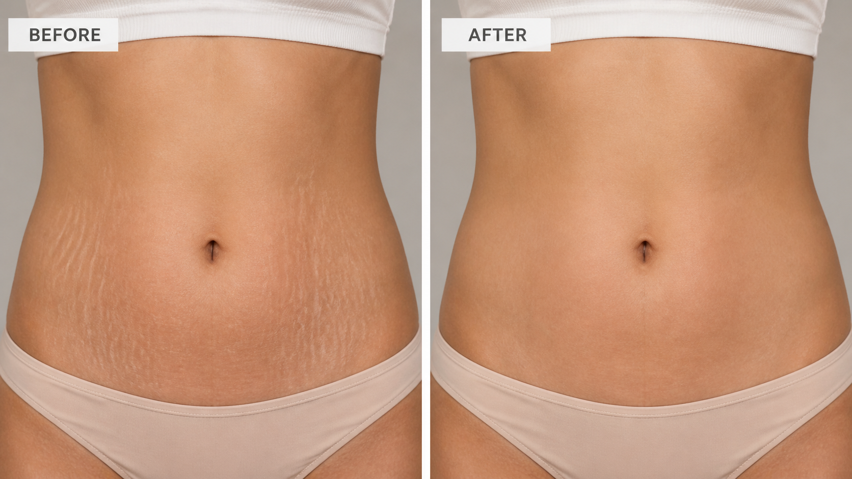 Before and after red light therapy for stretch marks - skin improvement comparison