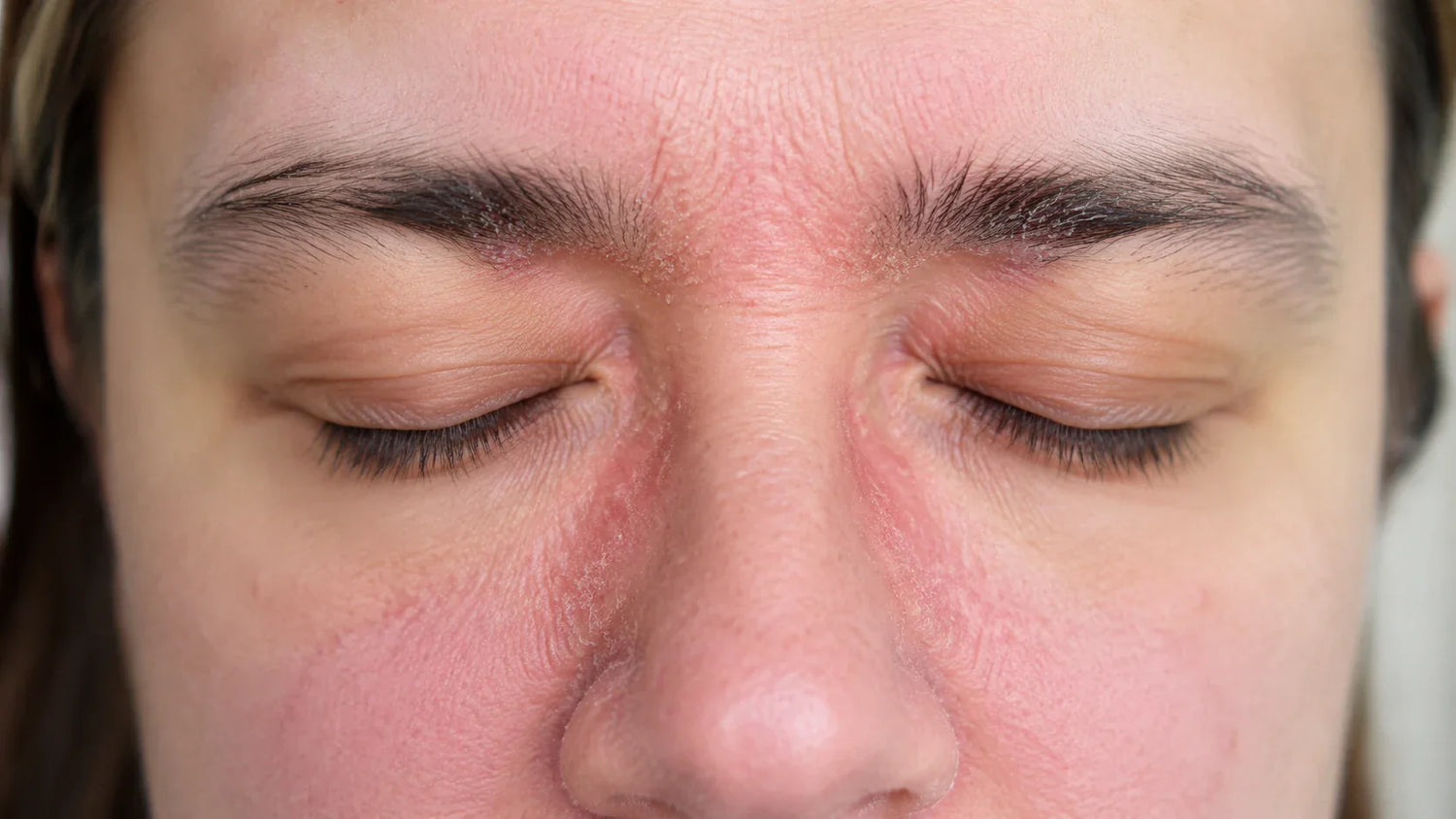 Red Light Therapy for Seborrhoeic Dermatitis (and Other Stubborn Skin Conditions): What the Science Actually Says