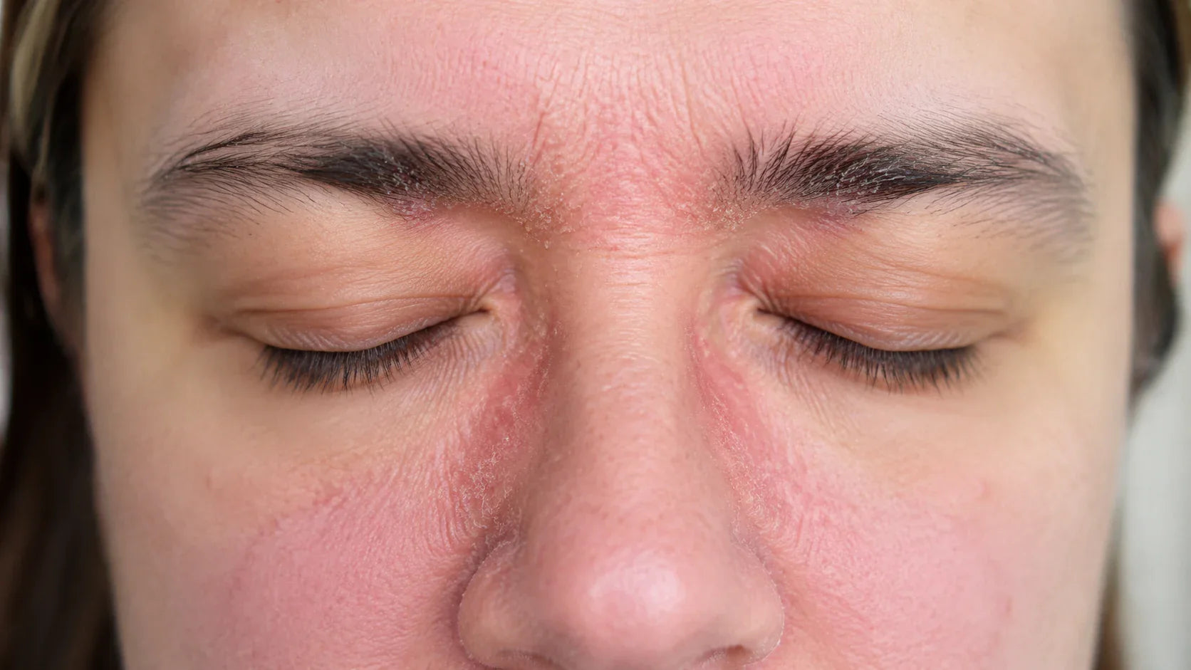 Red Light Therapy for Seborrhoeic Dermatitis (and Other Stubborn Skin Conditions): What the Science Actually Says